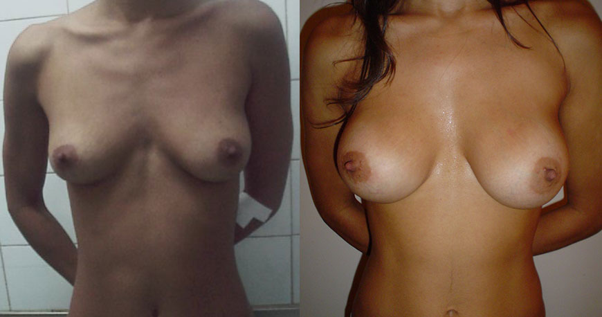 implante de mamas realizado en Porteiro & Pincelli